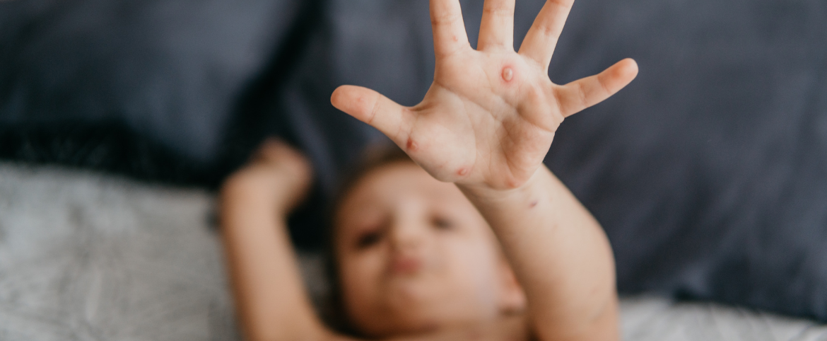 Smallpox and the Sanitary Revolution